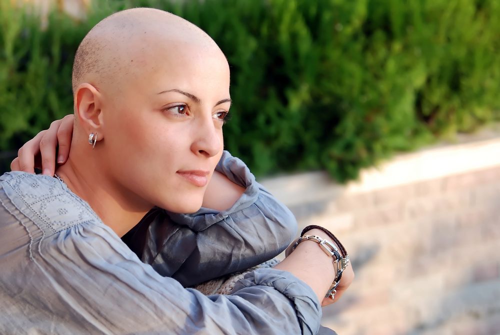 Woman with bald head, Alopecia Totalis